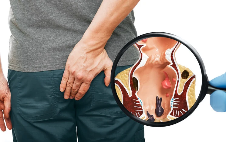 A man holding his lower back in discomfort, with a magnifying glass revealing a cross-section of the anal canal