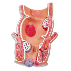 Anatomical model showing hemorrhoids within the anal canal