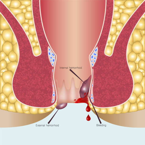 Cross-section diagram of the anal canal labelling internal and external hemorrhoids and bleeding